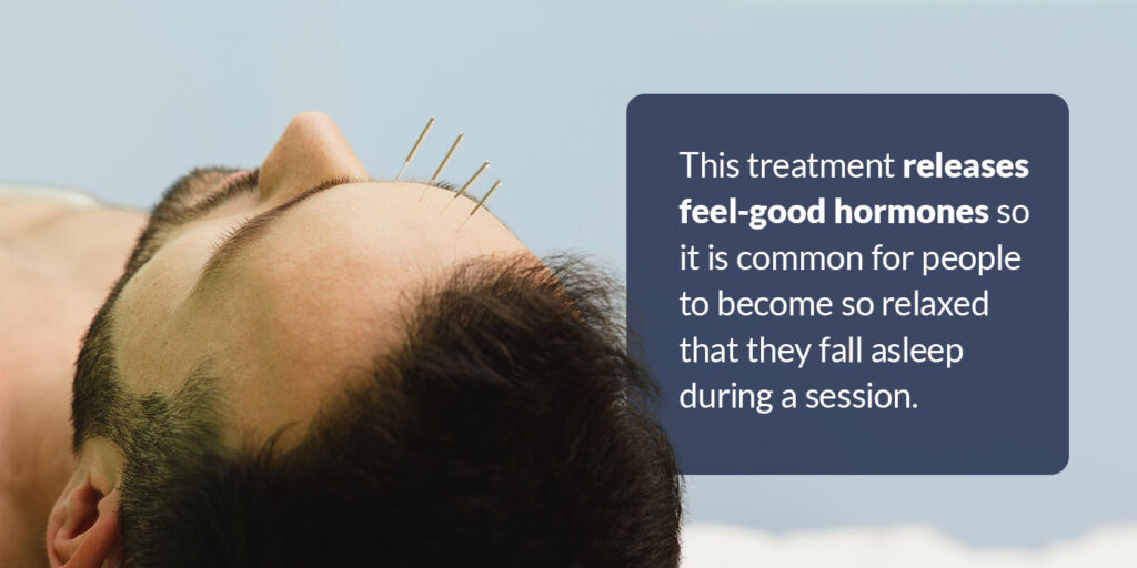 What Is Acupuncture for Migraine? What Is Acupuncture for Migraine?